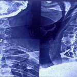 C-Spine-AP-LAT-View.jpg